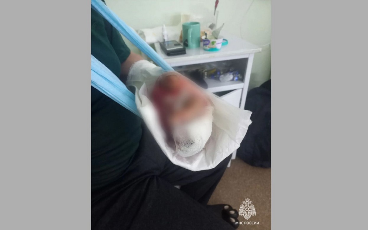 Мужчина получил перелом пальцев при запуске пиротехники в Удмуртии