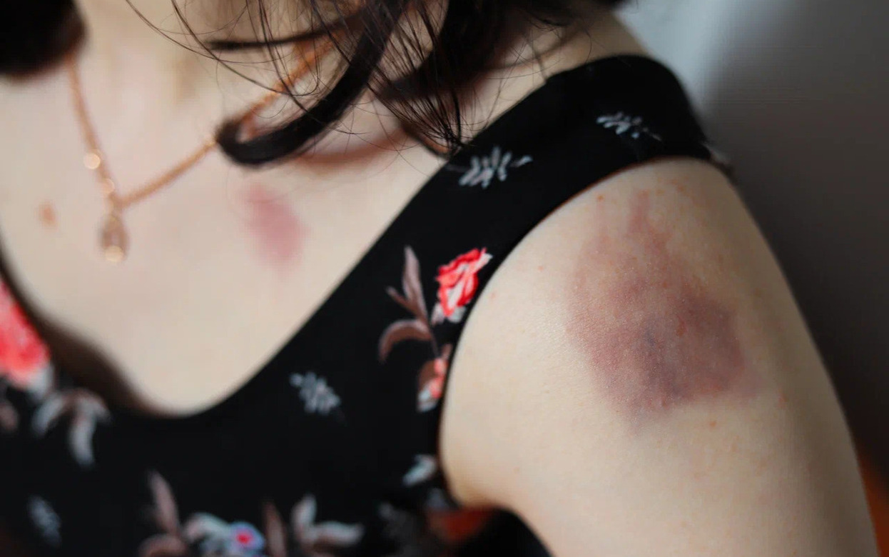 Топ-10 признаков псориаза: как вовремя распознать заболевание кожи