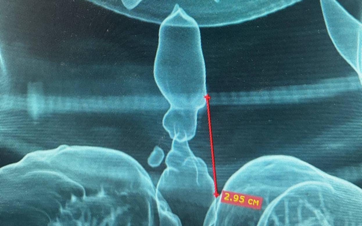 Хирурги в Ижевске восстановили дыхание жертве ДТП