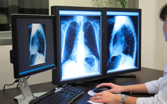 Заболеваемость туберкулезом в Удмуртии снизилась на 1,7%
