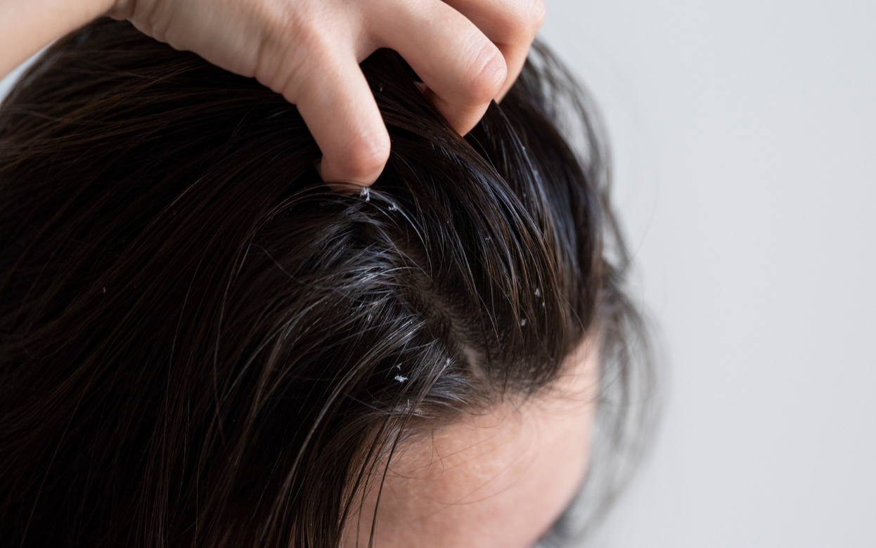 Белые хлопья на плечах: откуда берется перхоть и как вернуть здоровье коже головы