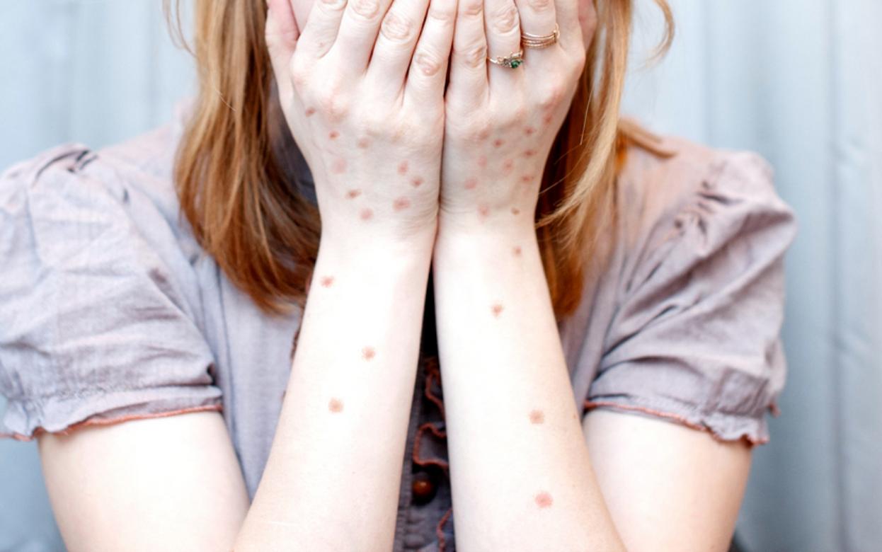 5 случаев кори выявили за 2025 г. в Удмуртии