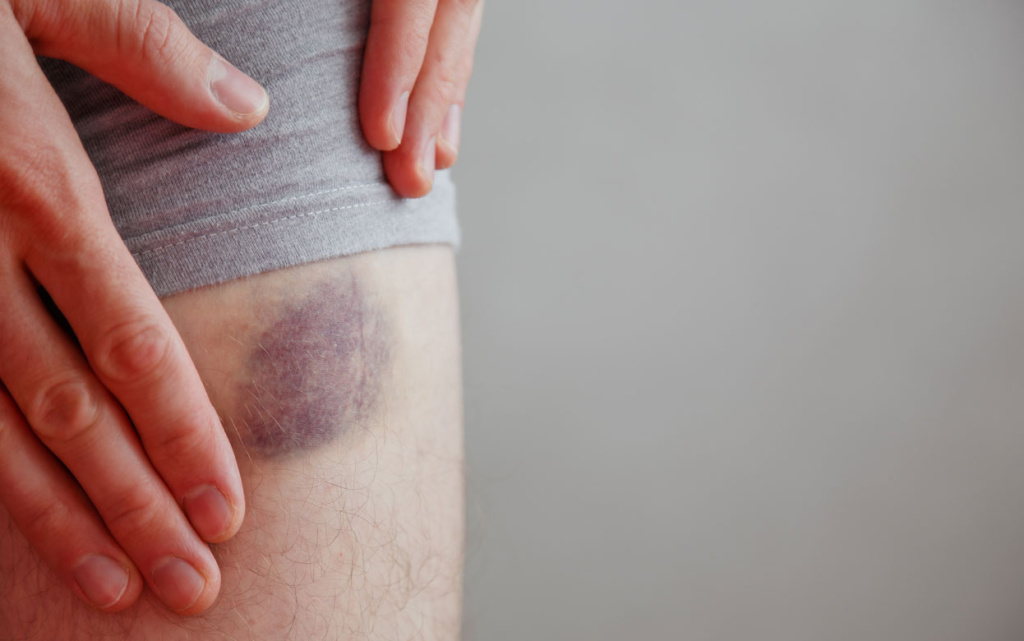 close-up-of-bruise-injury-o.jpg