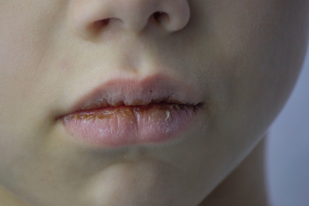 boy-with-chapped-lips-treatment-selective-focus-2026-03-24-03-42-08-utc.jpg