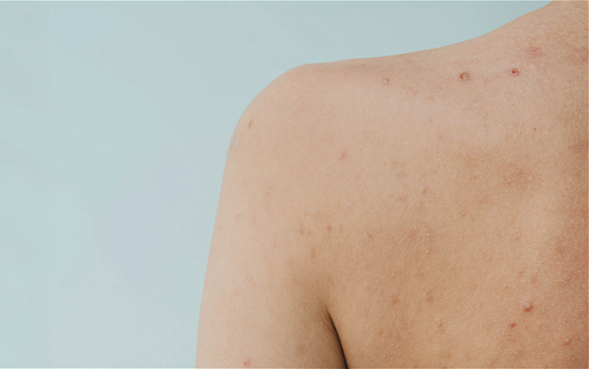 Рассказываем, что делать с прыщами на спине. Фото: envato elements. 