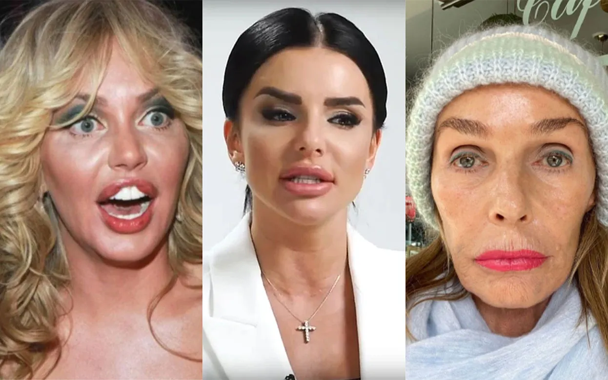 Пластиковый кошмар: знаменитые россиянки, которые сами себя изуродовали