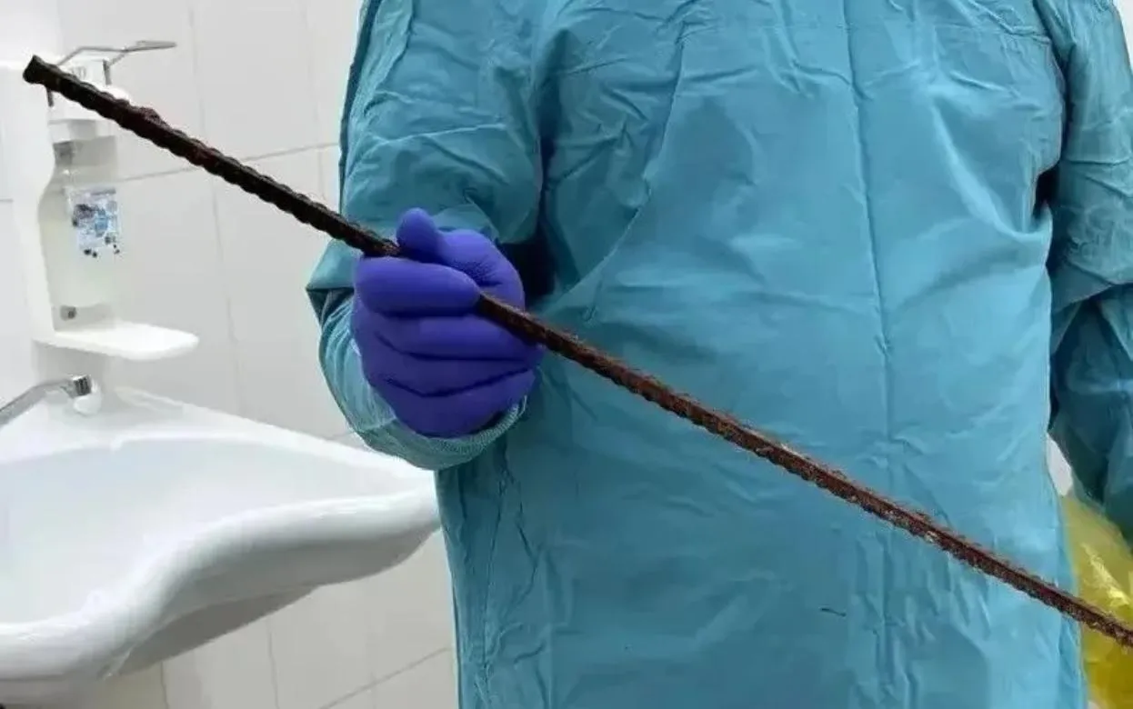 Хирурги в Ижевске извлекли арматуру из груди пациента