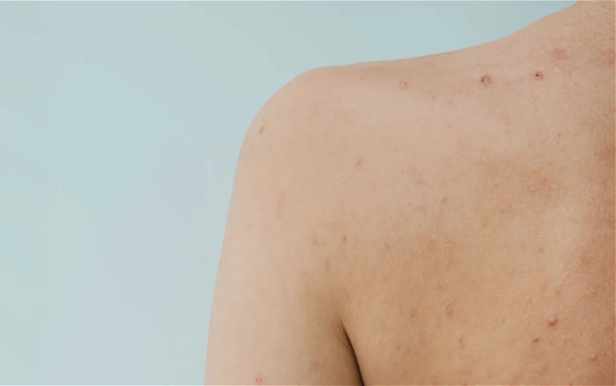 Не из-за грязи: дерматологи объяснили, почему появляются прыщи на спине и как их лечить правильно