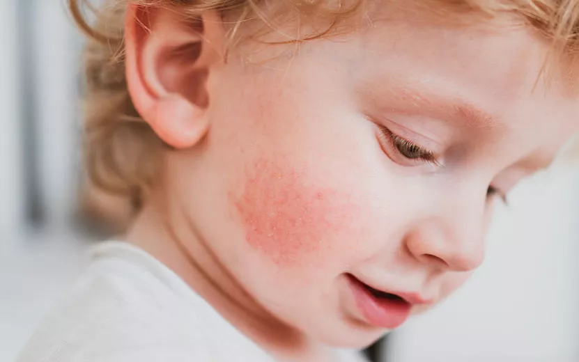 Поллиноз у ребенка: 11 советов аллерголога