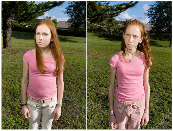 Став до и после. Дети с анорексией до и после. Подростки Анорексички.