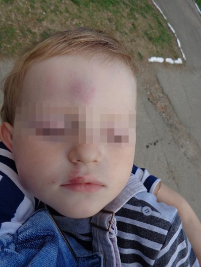 Ребенок получил травму в детсаду Ижевска: полицейские возбудили уголовное дело
