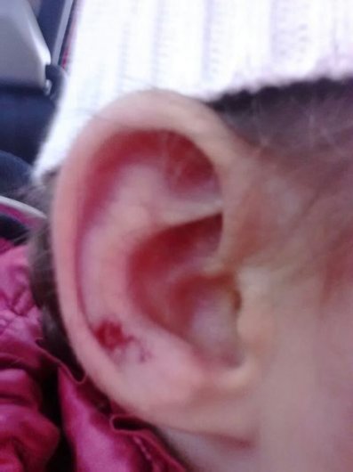 На набережной Ижевска пуля из пневматического ружья попала в ухо 4-х летней девочке