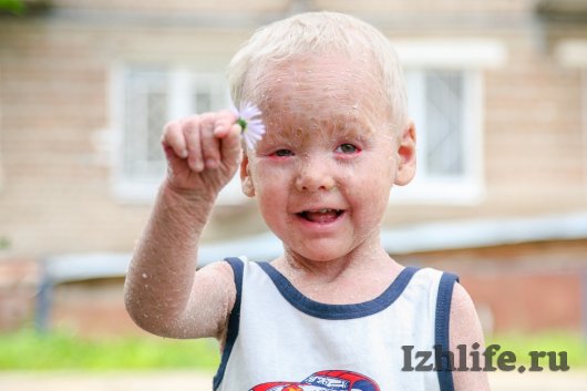 Ижевчане собрали более 60 000 рублей на лечение маленького Димы с редким заболеванием кожи
