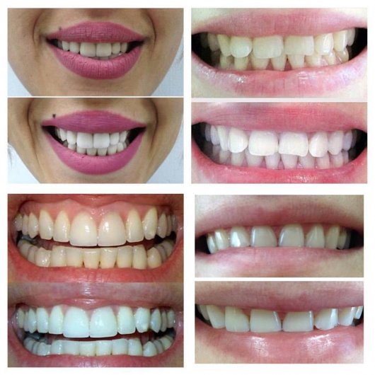 В Ижевске можно сделать голливудскую улыбку без похода к стоматологу